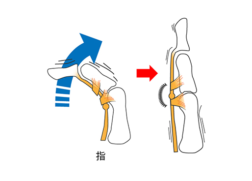 ばね指 指関節の痛み、指を伸ばしにくい