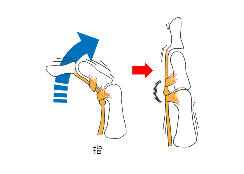 ばね指 指関節の痛み、指を伸ばしにくい