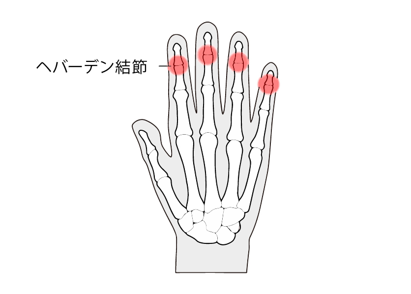 へバーデン結節 第一関節の腫れ・痛み・変形